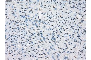 Immunohistochemical staining of paraffin-embedded Adenocarcinoma of colon tissue using anti-FCGR2A mouse monoclonal antibody. (FCGR2A Antikörper)