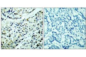Immunohistochemical analysis of paraffin-embedded human breast carcinoma tissue, using HDAC5 (phospho-Ser498) antibody (E011193). (HDAC5 Antikörper  (pSer498))