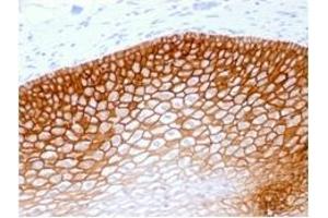 Formalin-fixed, paraffin-embedded human Cervical Squamous Cell Carcinoma stained withCD44v4 Mouse Recombinant Monoclonal Antibody (rCD44v4/1219). (Rekombinanter CD44 Antikörper)