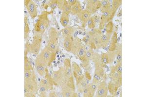 Immunohistochemistry of paraffin-embedded human liver cancer using SNAI2 Antibody (ABIN5970416) at dilution of 1/100 (40x lens). (SLUG Antikörper)