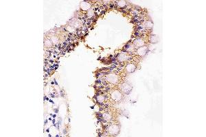 (ABIN6242350 and ABIN6577163) staining CADH1 in human colon tissue sections by Immunohistochemistry (IHC-P - paraformaldehyde-fixed, paraffin-embedded sections). (E-cadherin Antikörper  (AA 1-392))