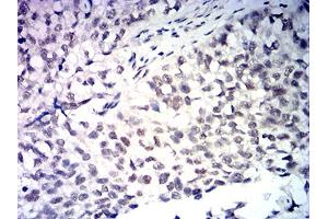 Immunohistochemical analysis of paraffin-embedded bladder cancer tissues using MDM2 mouse mAb with DAB staining. (MDM2 Antikörper  (AA 26-169))