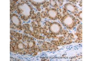 Immunohistochemistry of Human thyroid cancer using S100A1 Polyclonal Antibody at dilution of 1:40 (S100A1 Antikörper)
