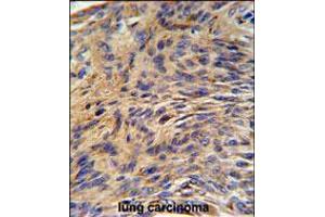 HSPA5 Antibody IHC analysis in formalin fixed and paraffin embedded human lung carcinoma followed by peroxidase conjugation of the secondary antibody and DAB staining. (GRP78 Antikörper  (AA 261-289))