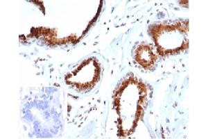 Formalin-fixed, paraffin-embedded human breast carcinoma stained with p27 Recombinant Mouse Monoclonal Antibody (rKIP1/1356). (Rekombinanter CDKN1B Antikörper)