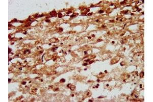 IHC image of ABIN7161596 diluted at 1:200 and staining in paraffin-embedded human melanoma performed on a Leica BondTM system. (Nidogen 1 Antikörper  (AA 792-942))