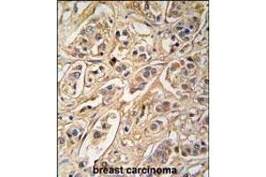 Formalin-fixed and paraffin-embedded human breast carcinoma tissue reacted with 14-3-3 protein zeta/delta antibody (C-term) (ABIN392782 and ABIN2842219) , which was peroxidase-conjugated to the secondary antibody, followed by DAB staining. (14-3-3 zeta Antikörper  (AA 216-245))