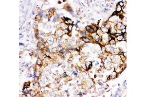 IHC-P: Heme Oxygenase 2 antibody testing of human lung cancer tissue (HMOX2 Antikörper  (AA 2-316))