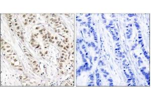 Immunohistochemical analysis of paraffin-embedded human breast carcinoma tissue, using BRCA1 (phospho-Ser1524) antibody (E011117). (BRCA1 Antikörper  (pSer1524))