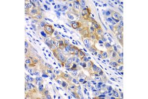 Immunohistochemistry of paraffin-embedded human gastric cancer using BCL2 antibody (ABIN5970041) at dilution of 1/100 (40x lens). (Bcl-2 Antikörper)