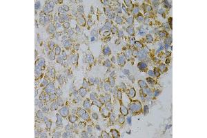 Immunohistochemistry of paraffin-embedded human esophageal cancer using GNAO1 Antibody. (GNAO1 Antikörper)