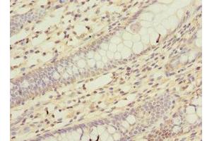 Immunohistochemistry of paraffin-embedded human colon cancer using ABIN7163978 at dilution of 1:100 (KCND2 Antikörper  (AA 501-630))