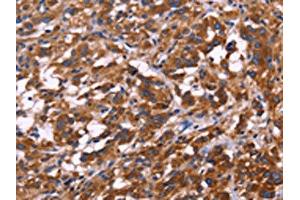 The image on the left is immunohistochemistry of paraffin-embedded Human thyroid cancer tissue using ABIN7129993(KIR2DL3/KIR2DL1/KIR2DL4/KIR2DS4 Antibody) at dilution 1/30, on the right is treated with fusion protein. (KIR2DL3/KIR2DL1/KIR2DL4/KIR2DS4 Antikörper)