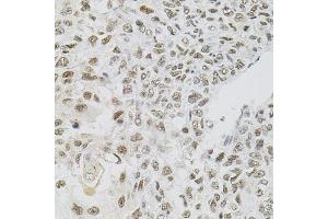 Immunohistochemistry of paraffin-embedded human lung cancer using FAF1 antibody (ABIN5975642) (40x lens). (FAF1 Antikörper)