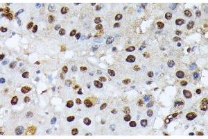 Immunohistochemistry of paraffin-embedded Human liver cancer using Phospho-ATF2(T69/T71) Polyclonal Antibody at dilution of 1:100 (40x lens). (ATF2 Antikörper  (pThr69, pThr71))