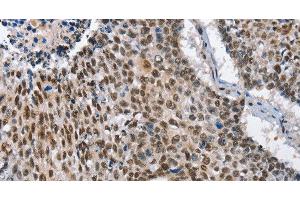 Immunohistochemistry of paraffin-embedded Human lung cancer tissue using GNRH1 Polyclonal Antibody at dilution 1:65 (GNRH1 Antikörper)