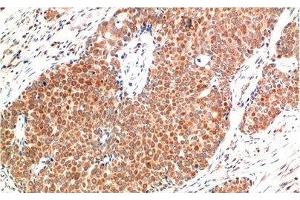 Immunohistochemistry of paraffin-embedded Human breast carcinoma tissue using ATM Monoclonal Antibody at dilution of 1:200. (ATM Antikörper)