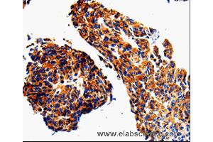 Immunohistochemistry of Human lung cancer using ADD1 Polyclonal Antibody at dilution of 1:50 (alpha Adducin Antikörper)