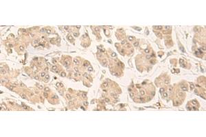 Immunohistochemistry of paraffin-embedded Human gastric cancer tissue using FABP4 Polyclonal Antibody at dilution of 1:60(x200) (FABP4 Antikörper)