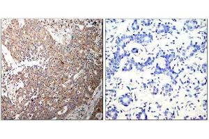 Immunohistochemical analysis of paraffin-embedded human breast carcinoma tissue using Keratin 18 (Ab-33) antibody (E021306). (Cytokeratin 18 Antikörper)