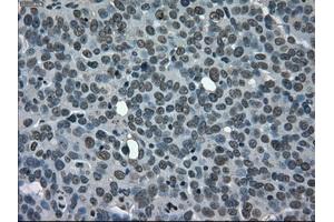 Immunohistochemical staining of paraffin-embedded Adenocarcinoma of ovary tissue using anti-CD4mouse monoclonal antibody. (CD4 Antikörper)