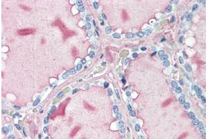 Human Thyroid (formalin-fixed, paraffin-embedded) stained with TG antibody ABIN396966 at 10 ug/ml followed by biotinylated anti-mouse IgG secondary antibody ABIN481714, alkaline phosphatase-streptavidin and chromogen. (Thyroglobulin Antikörper)