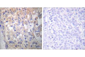 P-peptide - +Immunohistochemical analysis of paraffin-embedded human breast carcinoma tissue using Fyn (Phospho-Tyr530) antibody (#A0430). (FYN Antikörper  (pTyr530))