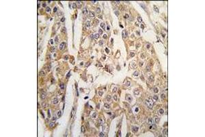 Formalin-fixed and paraffin-embedded human breast carcinoma tissue reacted with PKM2 antibody (C-term), which was peroxidase-conjugated to the secondary antibody, followed by DAB staining. (PKM2 Antikörper  (C-Term))