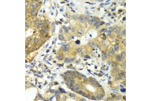 Immunohistochemistry of paraffin-embedded human gastric cancer using DPP3 antibody (ABIN6292042) at dilution of 1:100 (40x lens). (DPP3 Antikörper)