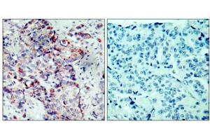 Immunohistochemical analysis of paraffin-embedded human breast carcinoma tissue, using SEK1/MKK4 (phospho-Ser80) antibody (E011177). (MAP2K4 Antikörper  (pSer80))