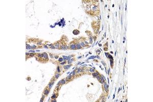 Immunohistochemistry of paraffin-embedded human stomach cancer using FABP3 antibody (ABIN5973057) at dilution of 1/200 (40x lens). (FABP3 Antikörper)