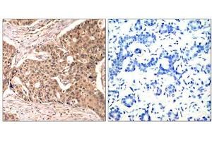 Immunohistochemical analysis of paraffin-embedded human breast carcinoma tissue using Paxillin (phospho-Tyr118) antibody (E011089). (Paxillin Antikörper  (pTyr118))