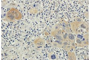 Immunohistochemical staining of human lung cancer using anti-Bax antibody. (Rekombinanter Bax (Active Monomer) (AA 12-24), (AA 3-16) Antikörper)