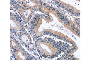 Immunohistochemistry of Human lymphoma using GDF11 Polyclonal Antibody at dilution of 1:30 (GDF11 Antikörper)