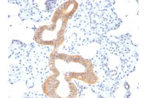 Formalin-fixed, paraffin-embedded human Melanoma stained with CD86 Mouse Monoclonal Antibody (SPM600). (CD86 Antikörper)