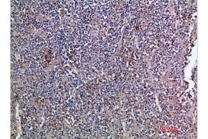 Immunohistochemical analysis of paraffin-embedded human-kidney-cancer, antibody was diluted at 1:200. (EGF Antikörper  (AA 1000-1060))