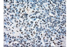 Immunohistochemical staining of paraffin-embedded Adenocarcinoma of breast tissue using anti-MAPK1 mouse monoclonal antibody. (ERK2 Antikörper)