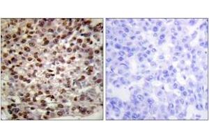 Immunohistochemistry analysis of paraffin-embedded human breast carcinoma tissue, using Histone H2B (Acetyl-Lys15) Antibody. (Histone H2B Antikörper  (acLys15))