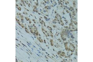 Immunohistochemistry of paraffin-embedded human colon carcinoma using GABPA antibody. (GABPA Antikörper)