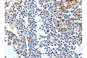 The image on the left is immunohistochemistry of paraffin-embedded Human tonsil tissue using ABIN7191316(LRP1 Antibody) at dilution 1/90, on the right is treated with synthetic peptide. (LRP1 Antikörper)