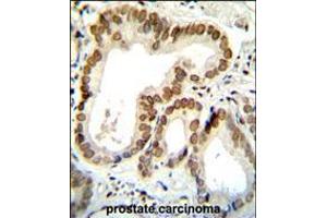 BTG2 Antibody immunohistochemistry analysis in formalin fixed and paraffin embedded human prostate carcinoma followed by peroxidase conjugation of the secondary antibody and DAB staining. (BTG2 Antikörper  (N-Term))