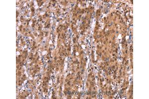 Immunohistochemistry of Human thyroid cancer using AMER1 Polyclonal Antibody at dilution of 1:40 (WTX Antikörper)