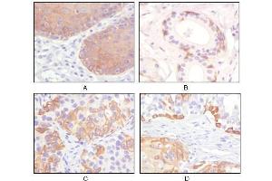 Immunohistochemical analysis of paraffin-embedded human esophagus epithelium (A), salivary gland basal cell (B), lung squamous cell carcinoma (C), endometrium admosquamous carcinoma (D), showing cytoplasmic and membrane localization using CK5 antibody with DAB staining. (Cytokeratin 5 Antikörper)