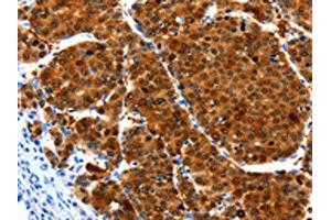 The image on the left is immunohistochemistry of paraffin-embedded Human liver cancer tissue using ABIN7190937(HIBADH Antibody) at dilution 1/25, on the right is treated with synthetic peptide. (HIBADH Antikörper)