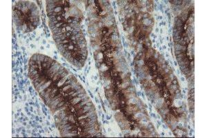 Immunohistochemical staining of paraffin-embedded Adenocarcinoma of Human endometrium tissue using anti-FOLH1 mouse monoclonal antibody. (PSMA Antikörper)