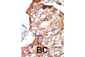 Formalin-fixed and paraffin-embedded human cancer tissue reacted with the primary antibody, which was peroxidase-conjugated to the secondary antibody, followed by DAB staining. (ZAP70 Antikörper  (AA 252-282))