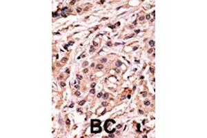 Formalin-fixed and paraffin-embedded human cancer tissue reacted with the primary antibody, which was peroxidase-conjugated to the secondary antibody, followed by AEC staining. (p53 Antikörper  (pSer20))