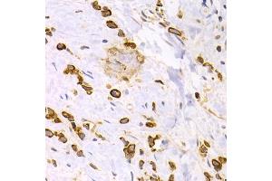 Immunohistochemistry of paraffin-embedded human gastric cancer using KRT15 antibody. (KRT15 Antikörper)