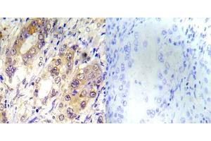 Immunohistochemical analysis of paraffin-embedded human lung carcinoma tissue using Tsc2 (phospho-Thr1462) antibody (E012050). (Tuberin Antikörper  (pThr1462))