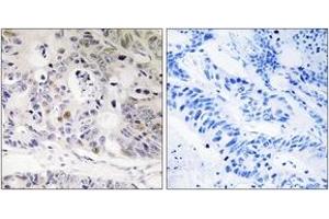 Immunohistochemistry analysis of paraffin-embedded human colon carcinoma tissue, using UBTD1 Antibody. (UBTD1 Antikörper  (AA 151-200))